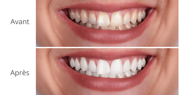 Résultat blanchiment 1