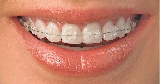 Orthodontie Classique - Bagues Dentaires